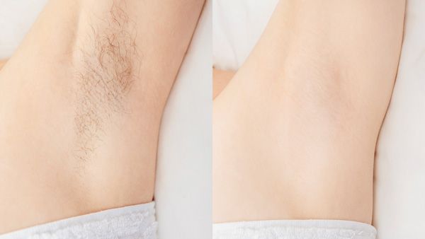 Laser Hair Removal in Tucson Before and After
