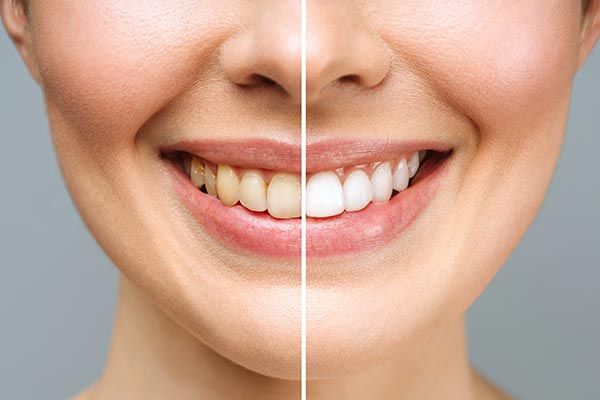 Before and After Teeth Whitening