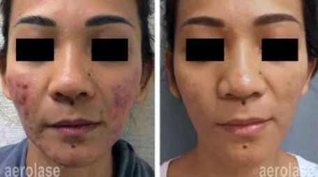 Aerolase Acne Treatment Before and After