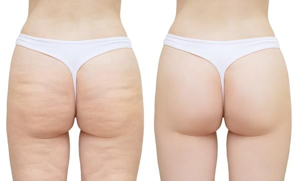 Before and After Body Contouring Tucson