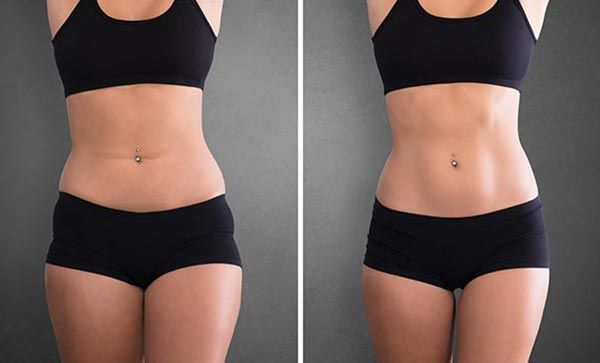 RF Body Contouring Before and After Photo Gallery