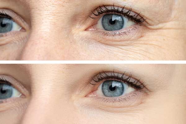 Before and After Procedure