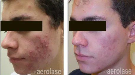 Aerolase Acne Treatment Before and After