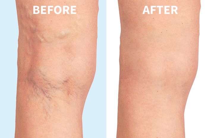 Before and After Vein Treatments in Tucson